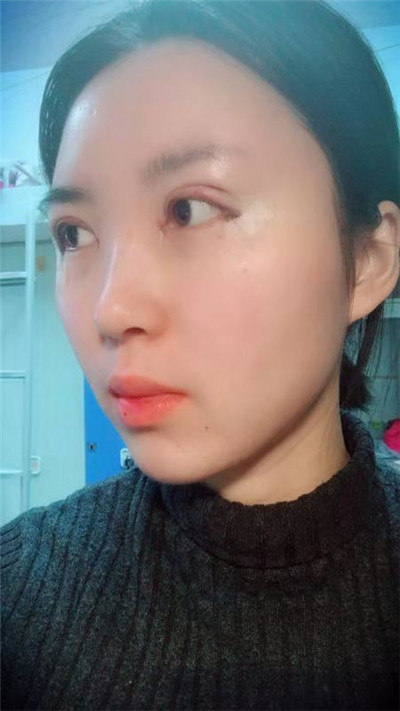 蚌埠美莱坞张迪眼部综合怎么样?价格案例分享