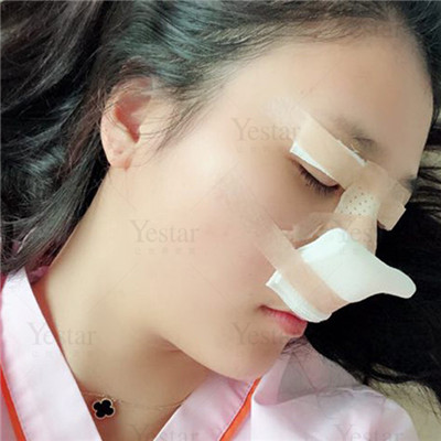 济南艺星杨季涛鼻部手术怎么样?价格案例分享