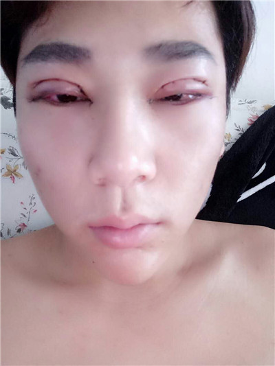 铜仁韩美时光肖曙光切开双眼皮怎么样?价格案例分享