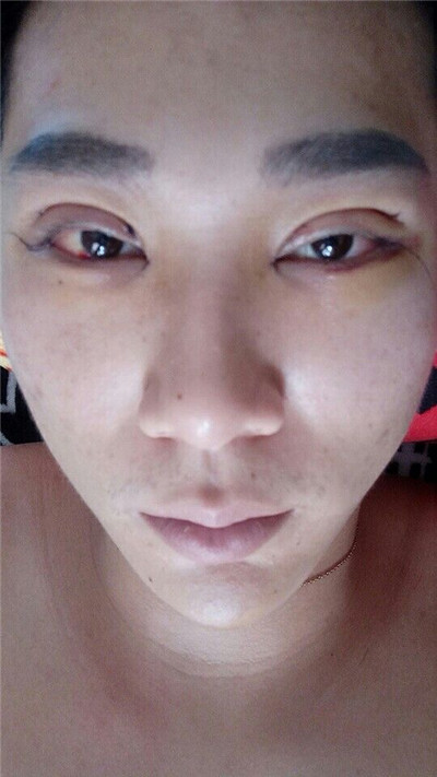 铜仁韩美时光肖曙光切开双眼皮怎么样?价格案例分享