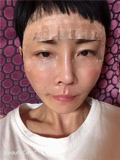 济南艺星杨季涛脂肪全脸填充怎么样?价格案例分享