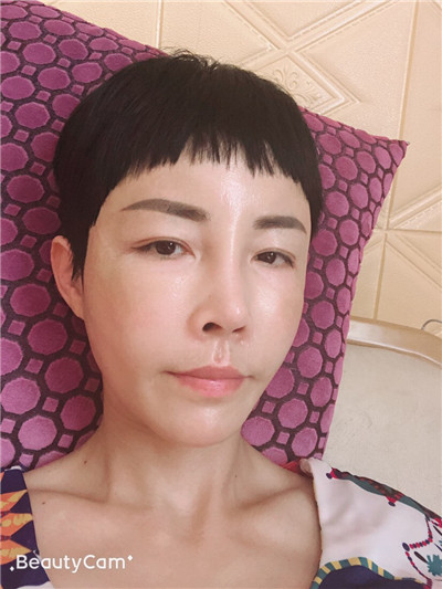 济南艺星杨季涛脂肪全脸填充怎么样?价格案例分享
