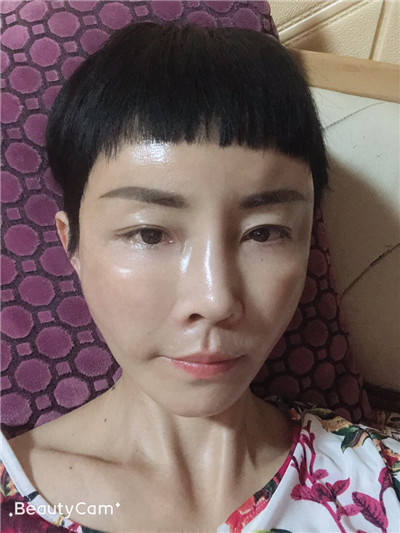 济南艺星杨季涛脂肪全脸填充怎么样?价格案例分享