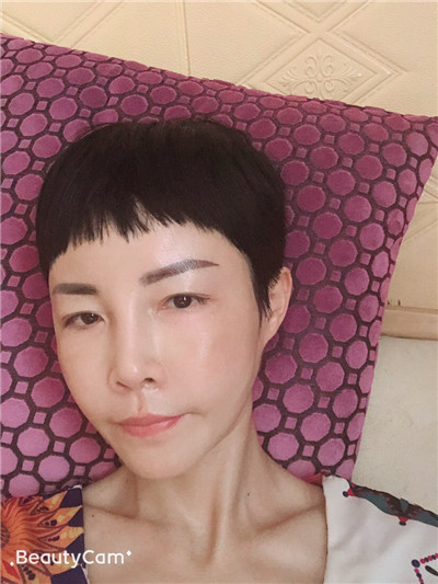 济南艺星杨季涛脂肪全脸填充怎么样?价格案例分享