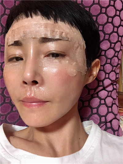 济南艺星杨季涛脂肪全脸填充怎么样?价格案例分享