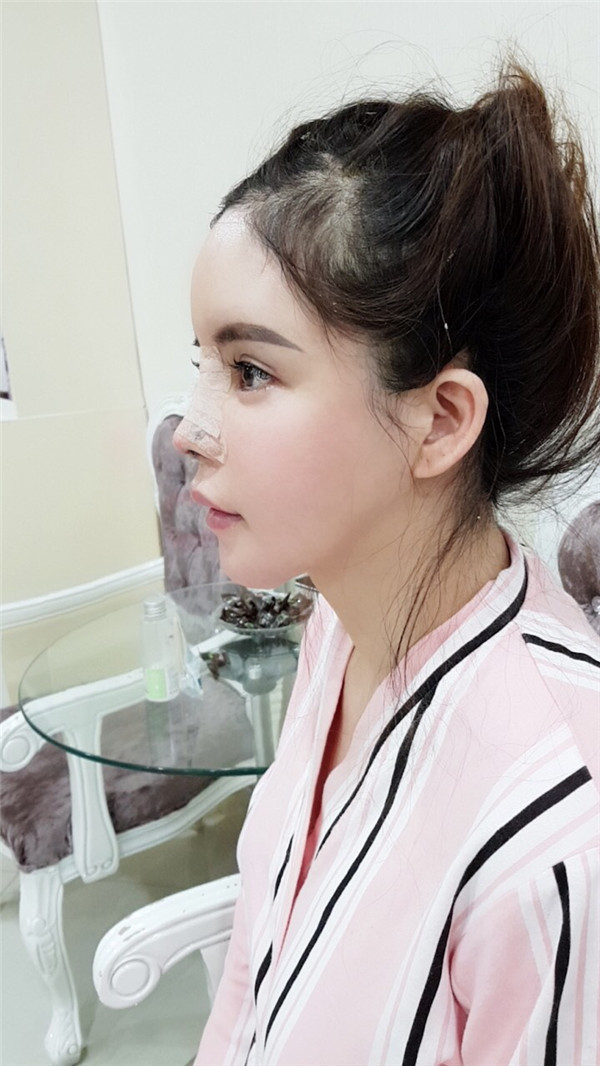 上海喜美王会勇鼻修复怎么样?价格案例