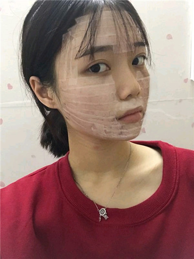 济南星光姜冬宁自体脂肪填充怎么样?价格案例分享