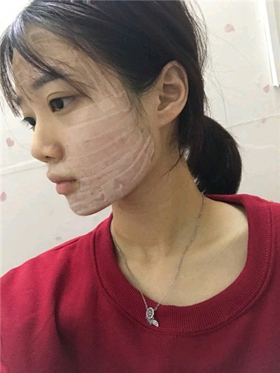 济南星光姜冬宁自体脂肪填充怎么样?价格案例分享