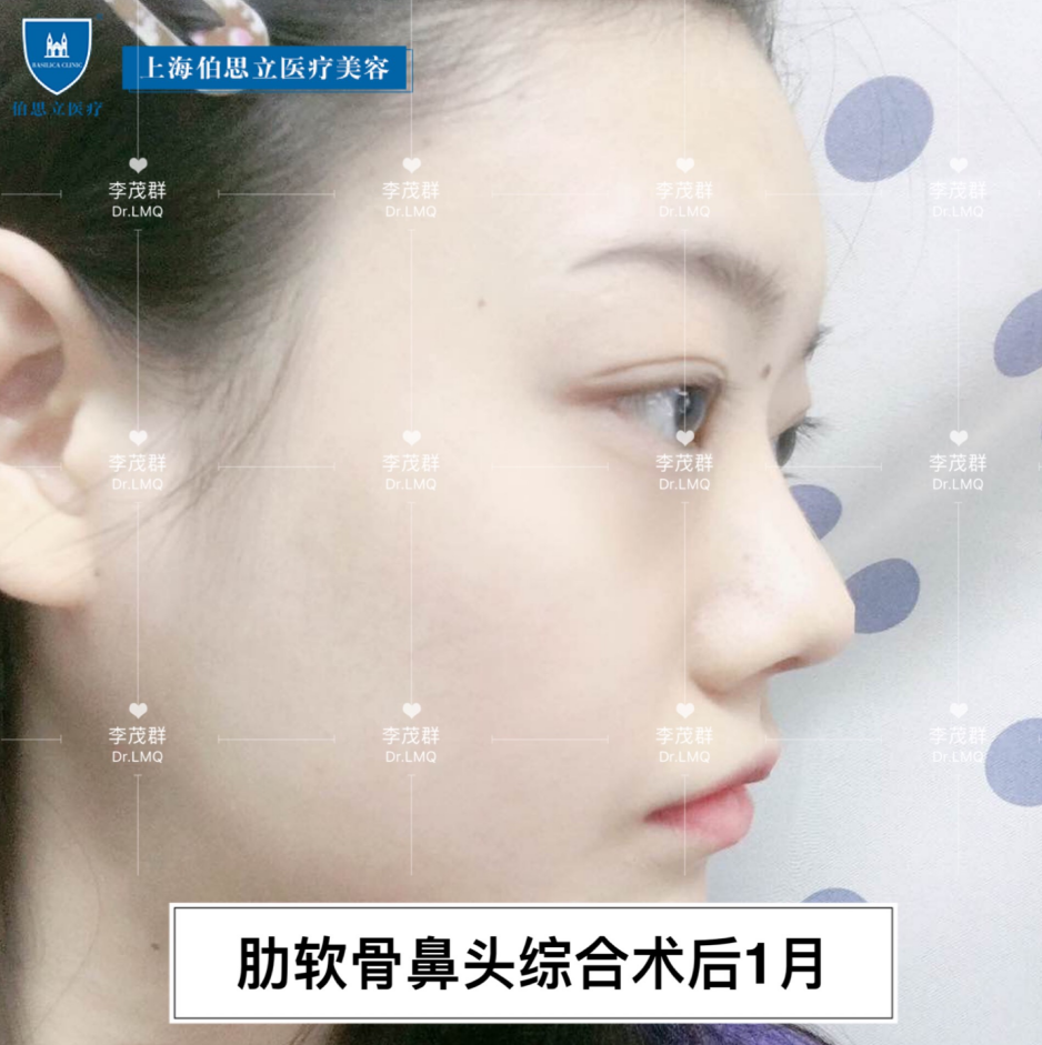 隆鼻切口是怎么样?会不会留疤?
