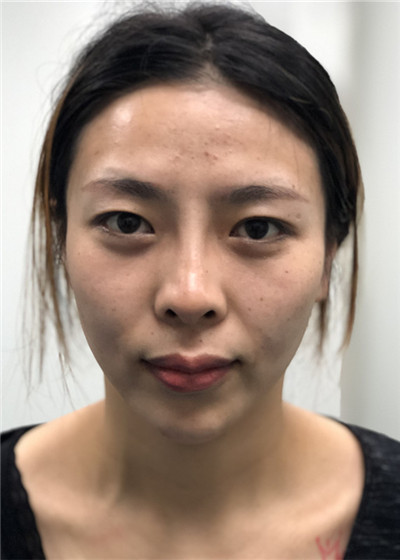 合肥亚典陈录翔眼部综合怎么样?价格案例分享