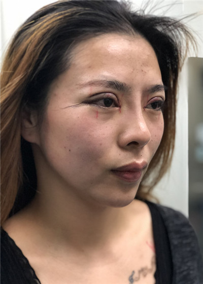 合肥亚典陈录翔眼部综合怎么样?价格案例分享