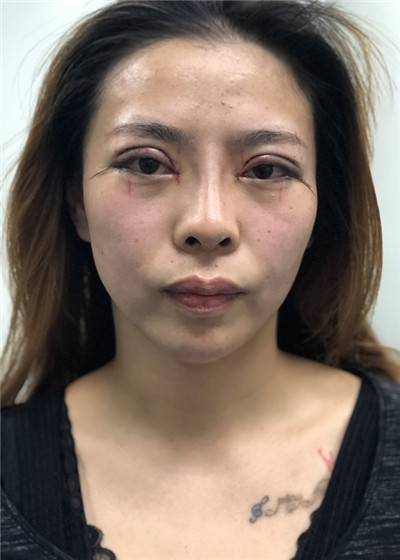 合肥亚典陈录翔眼部综合怎么样?价格案例分享
