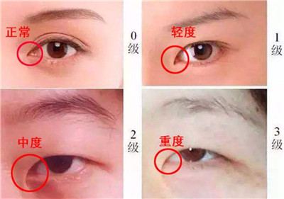 开眼角的作用有哪些?果好不好?