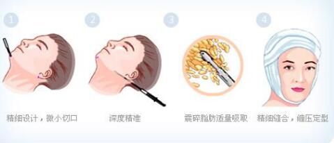 面部吸脂是什么,果好不好?