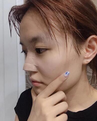 南昌佳美周方宾鼻部手术怎么样?价格案例分享