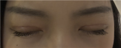深圳南雅张燕发切开双眼皮怎么样?价格案例分享
