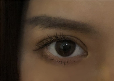 深圳南雅张燕发切开双眼皮怎么样?价格案例分享