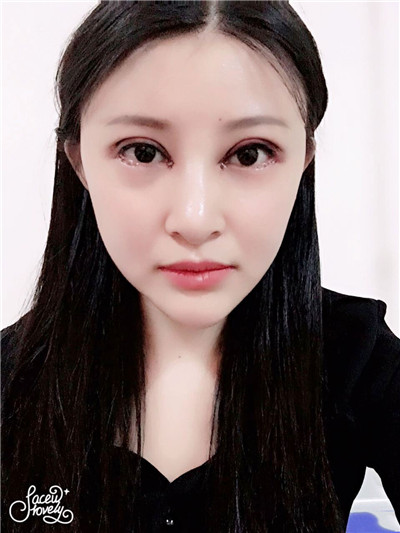 上海悦莱眼部综合唐勇怎么样?价格案例分享