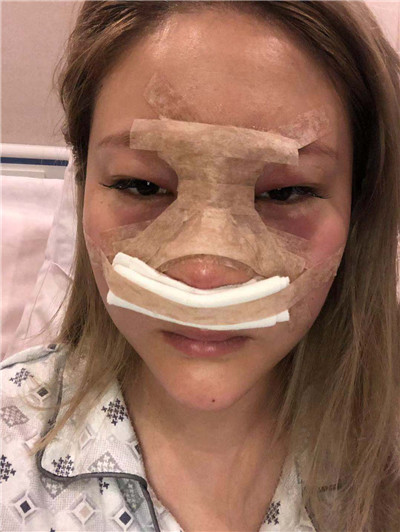 成都润美玉之光黄开亮肋软骨隆鼻怎么样?价格案例分享