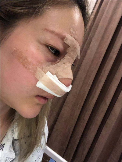 成都润美玉之光黄开亮肋软骨隆鼻怎么样?价格案例分享