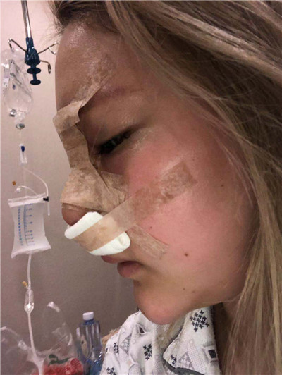 成都润美玉之光黄开亮肋软骨隆鼻怎么样?价格案例分享