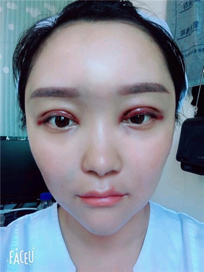 重庆艺星王方鹏切开双眼皮怎么样?价格案例分享