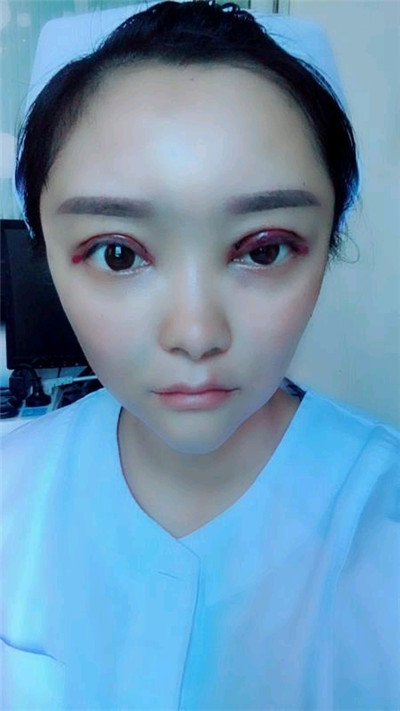重庆艺星王方鹏切开双眼皮怎么样?价格案例分享