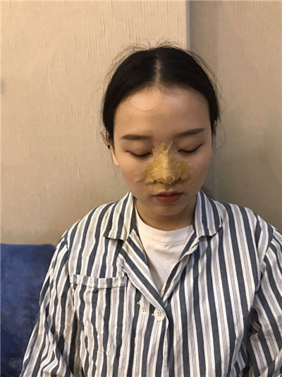 南宁悦星朱小平鼻部手术怎么样?价格案例分享