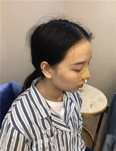 南宁悦星朱小平鼻部手术怎么样?价格案例分享