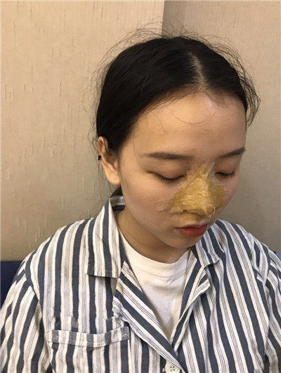 南宁悦星朱小平鼻部手术怎么样?价格案例分享