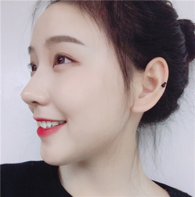 南宁悦星朱小平鼻部手术怎么样?价格案例分享