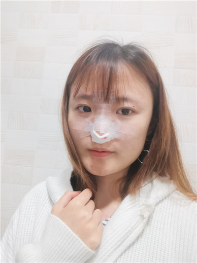 北京艺星薛轶群鼻部手术怎么样?价格案例分享