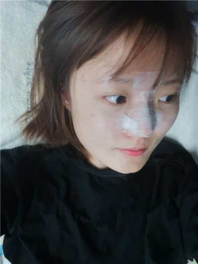 北京艺星薛轶群鼻部手术怎么样?价格案例分享
