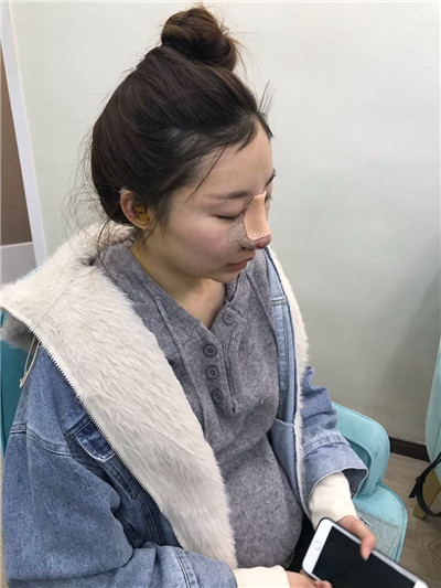 北京亚楠容悦蒋亚楠鼻部手术怎么样?价格案例分享