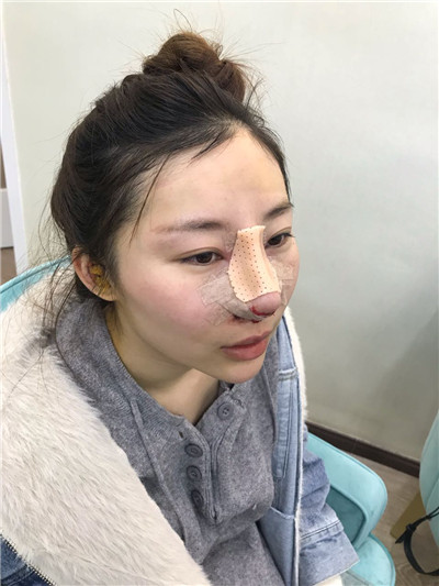 北京亚楠容悦蒋亚楠鼻部手术怎么样?价格案例分享