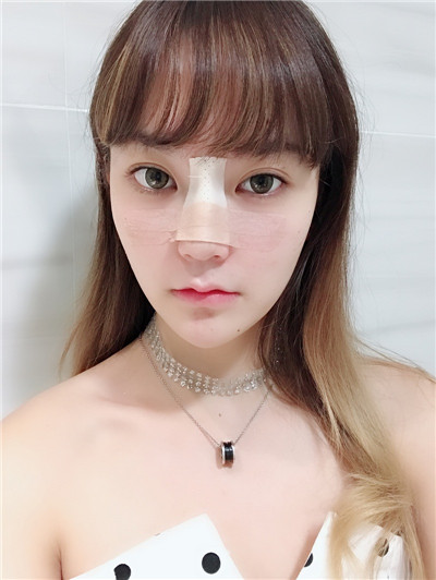 北京艺星薛轶群膨体隆鼻怎么样?价格案例分享