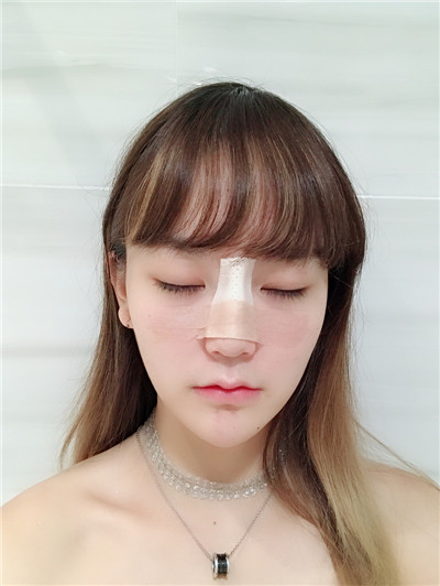 北京艺星薛轶群膨体隆鼻怎么样?价格案例分享