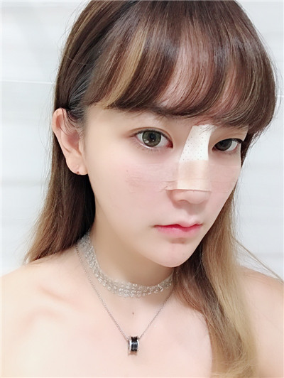 北京艺星薛轶群膨体隆鼻怎么样?价格案例分享