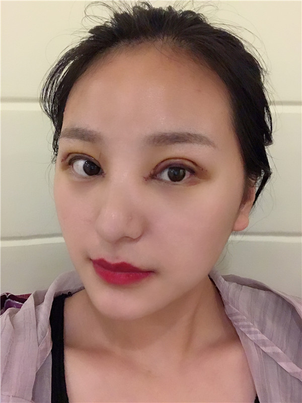 重庆亚美蜜园田学勤眼部手术怎么样?价格案例