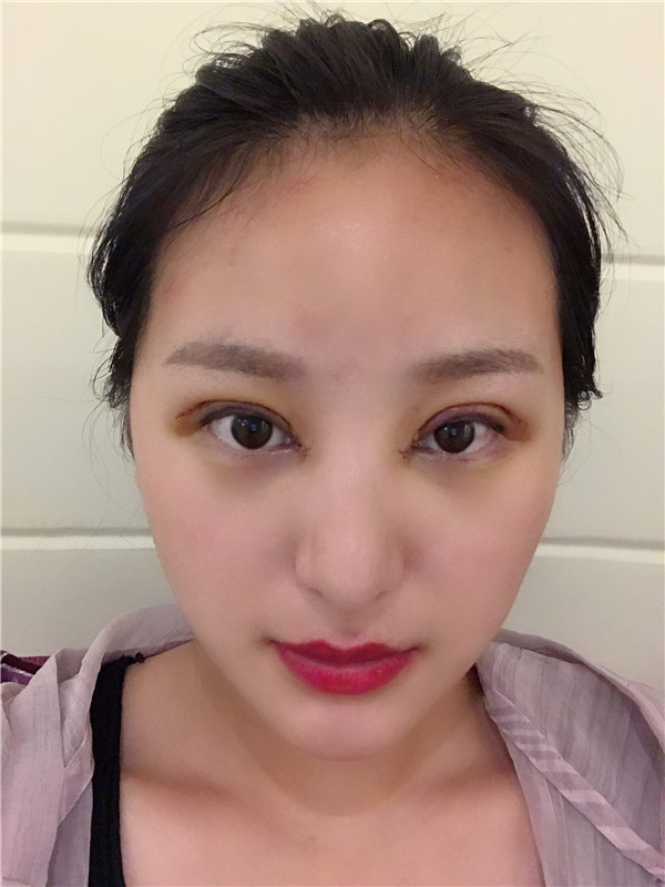 重庆亚美蜜园田学勤眼部手术怎么样?价格案例