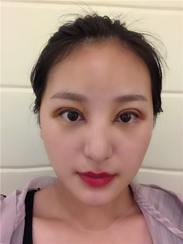 重庆亚美蜜园田学勤眼部手术怎么样?价格案例