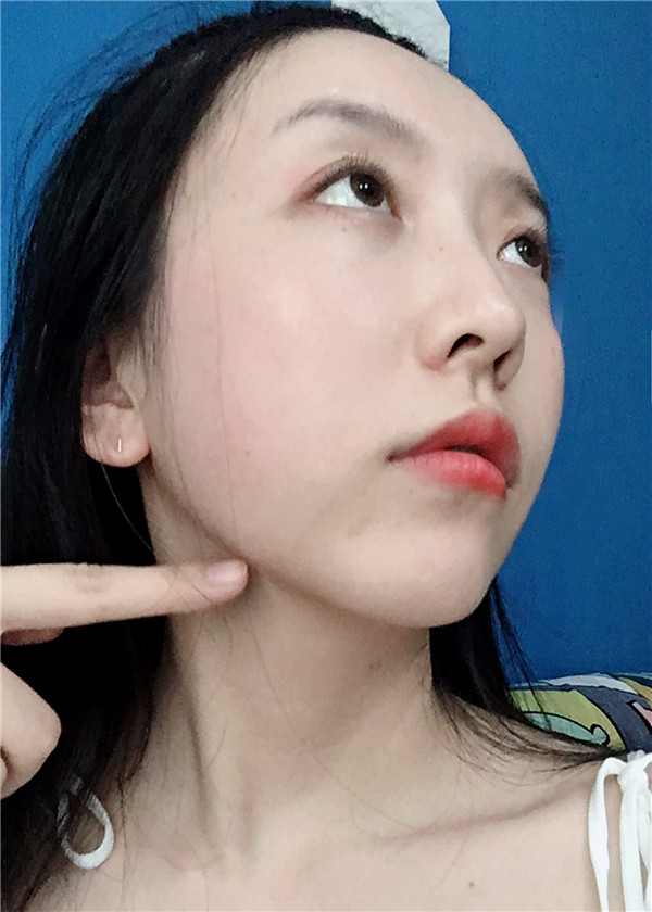 金陵嘉怡美吸脂怎么样?价格案例115天