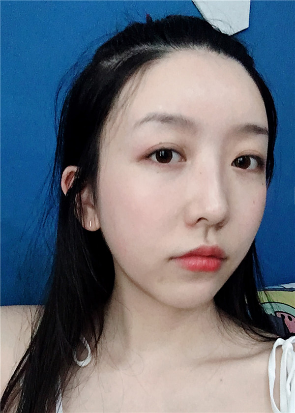 金陵嘉怡美吸脂怎么样?价格案例115天