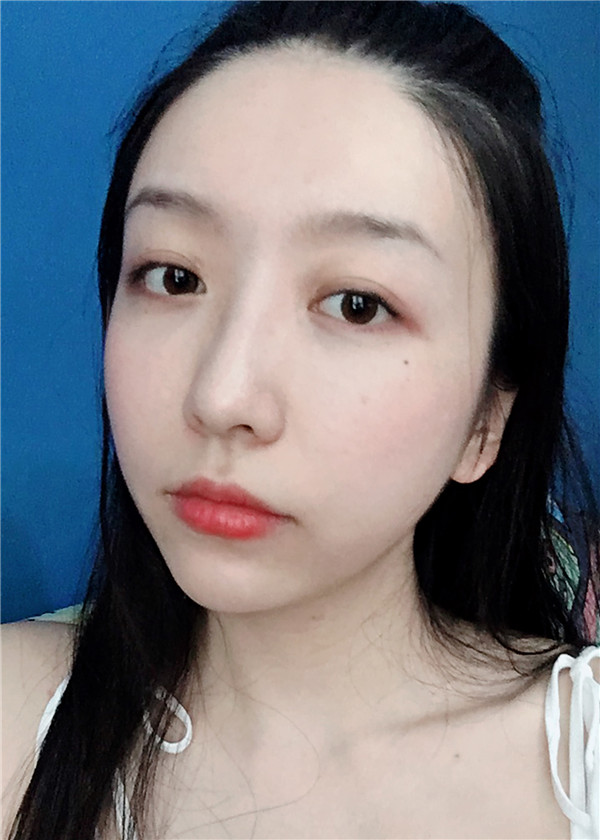 金陵嘉怡美吸脂怎么样?价格案例115天
