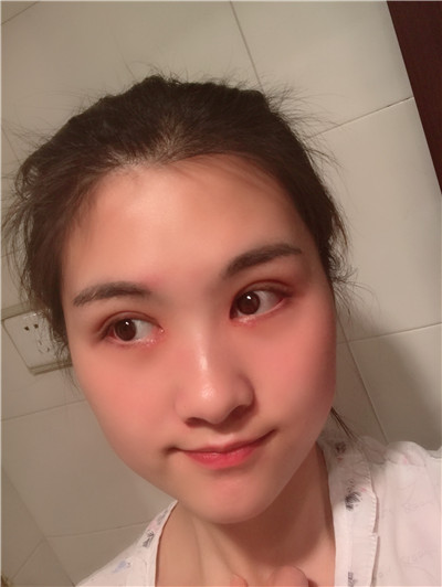 重庆新铜雀台开内眼角怎么样?价格案例分享
