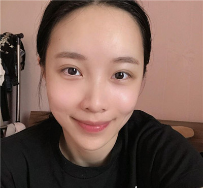 武汉中翰朱东磊脂肪全脸填充怎么样?价格案例分享