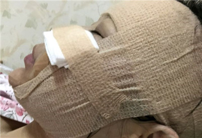 武汉中翰朱东磊脂肪全脸填充怎么样?价格案例分享