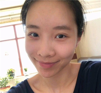 武汉中翰朱东磊脂肪全脸填充怎么样?价格案例分享