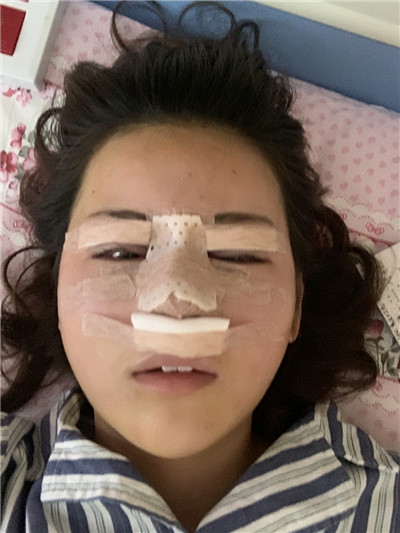贵阳华美杜良军鼻部手术怎么样?价格案例分享