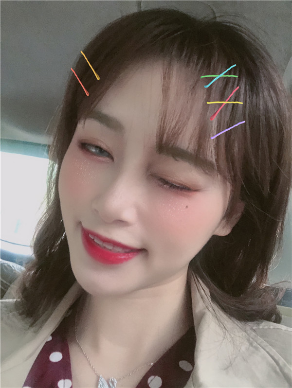 杭州艾尔莎奥拉克双眼皮怎么样?价格案例137天